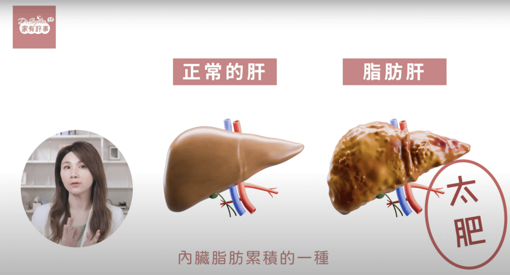 fatty liver